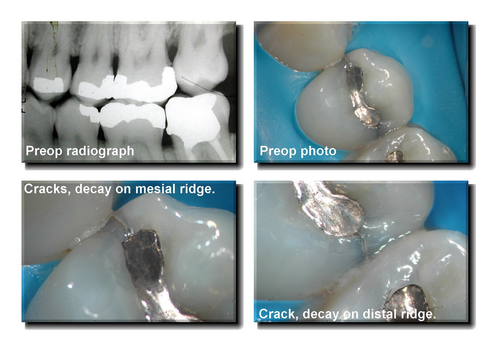 Cracked tooth pg 1_resize.jpg